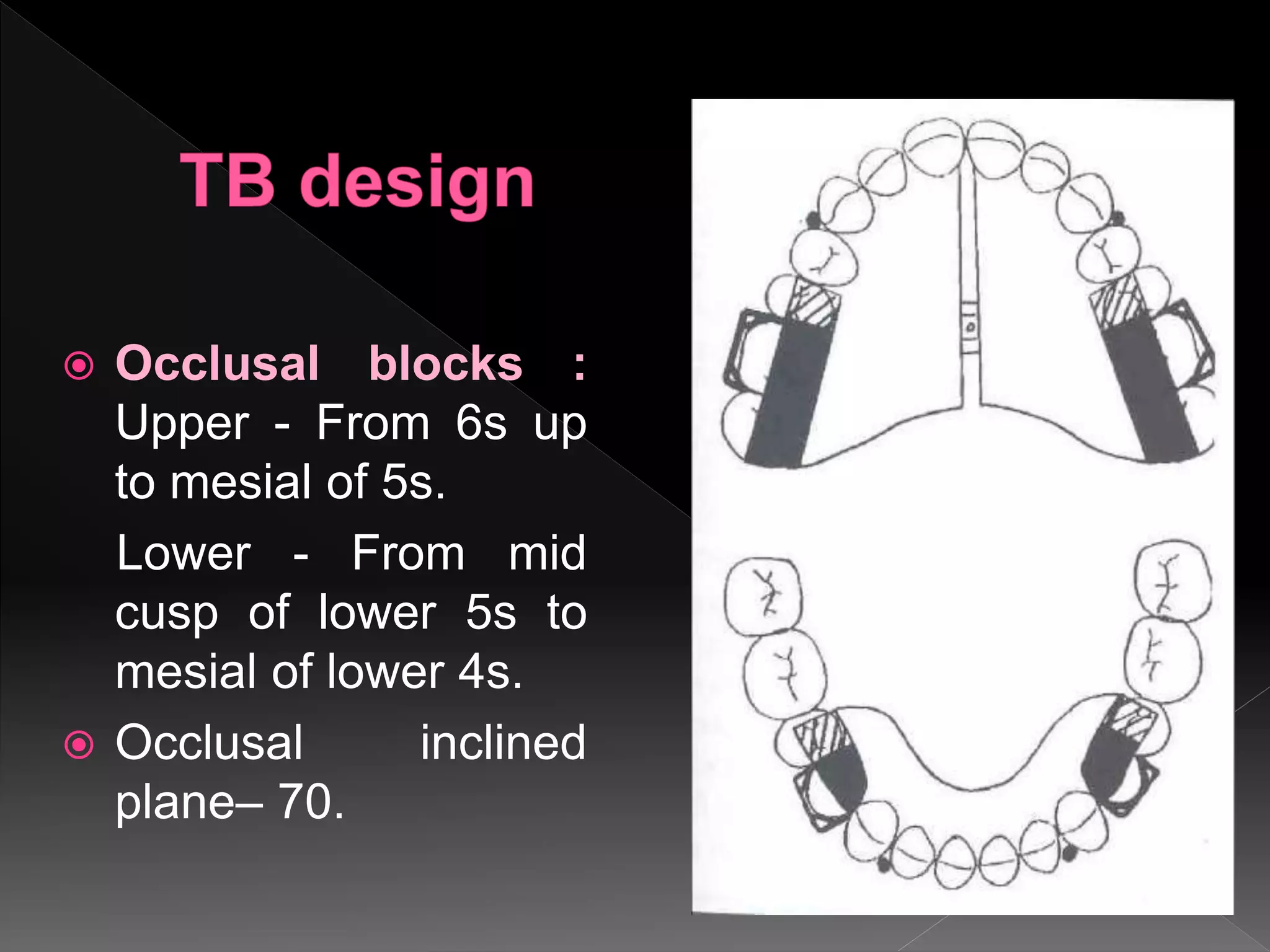  Occlusal blocks :
Upper - From 6s up
to mesial of 5s.
Lower - From mid
cusp of lower 5s to
mesial of lower 4s.
 Occlusal inclined
plane– 70.
 