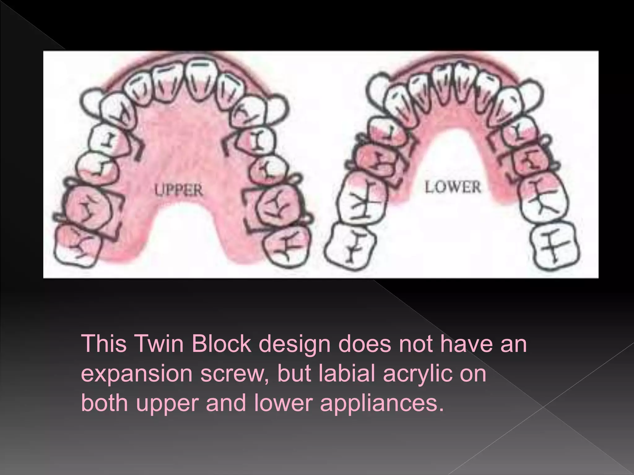 This Twin Block design does not have an
expansion screw, but labial acrylic on
both upper and lower appliances.
 