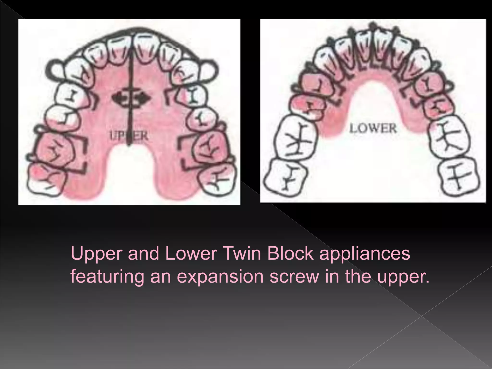 Upper and Lower Twin Block appliances
featuring an expansion screw in the upper.
 