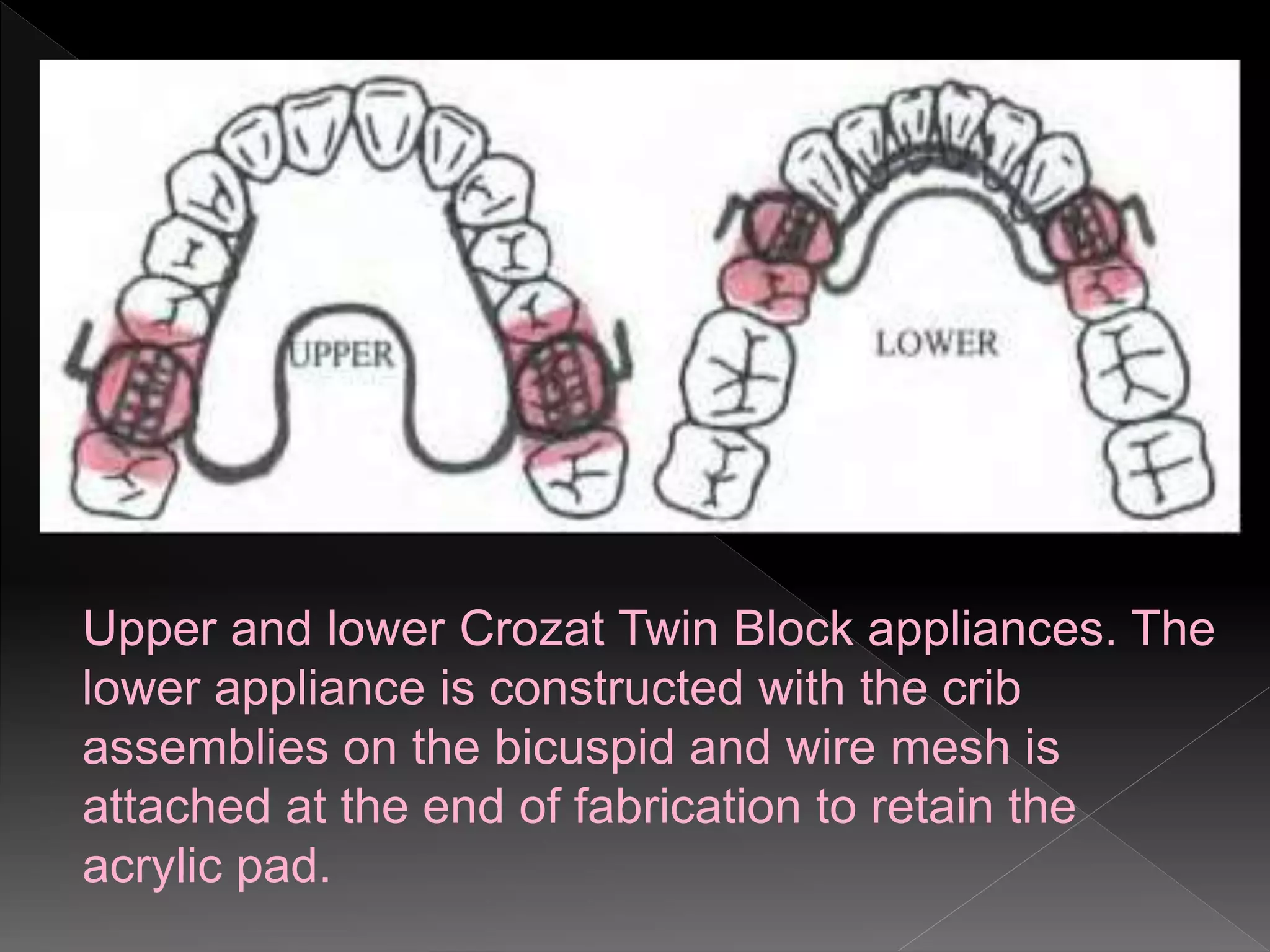 Upper and lower Crozat Twin Block appliances. The
lower appliance is constructed with the crib
assemblies on the bicuspid and wire mesh is
attached at the end of fabrication to retain the
acrylic pad.
 