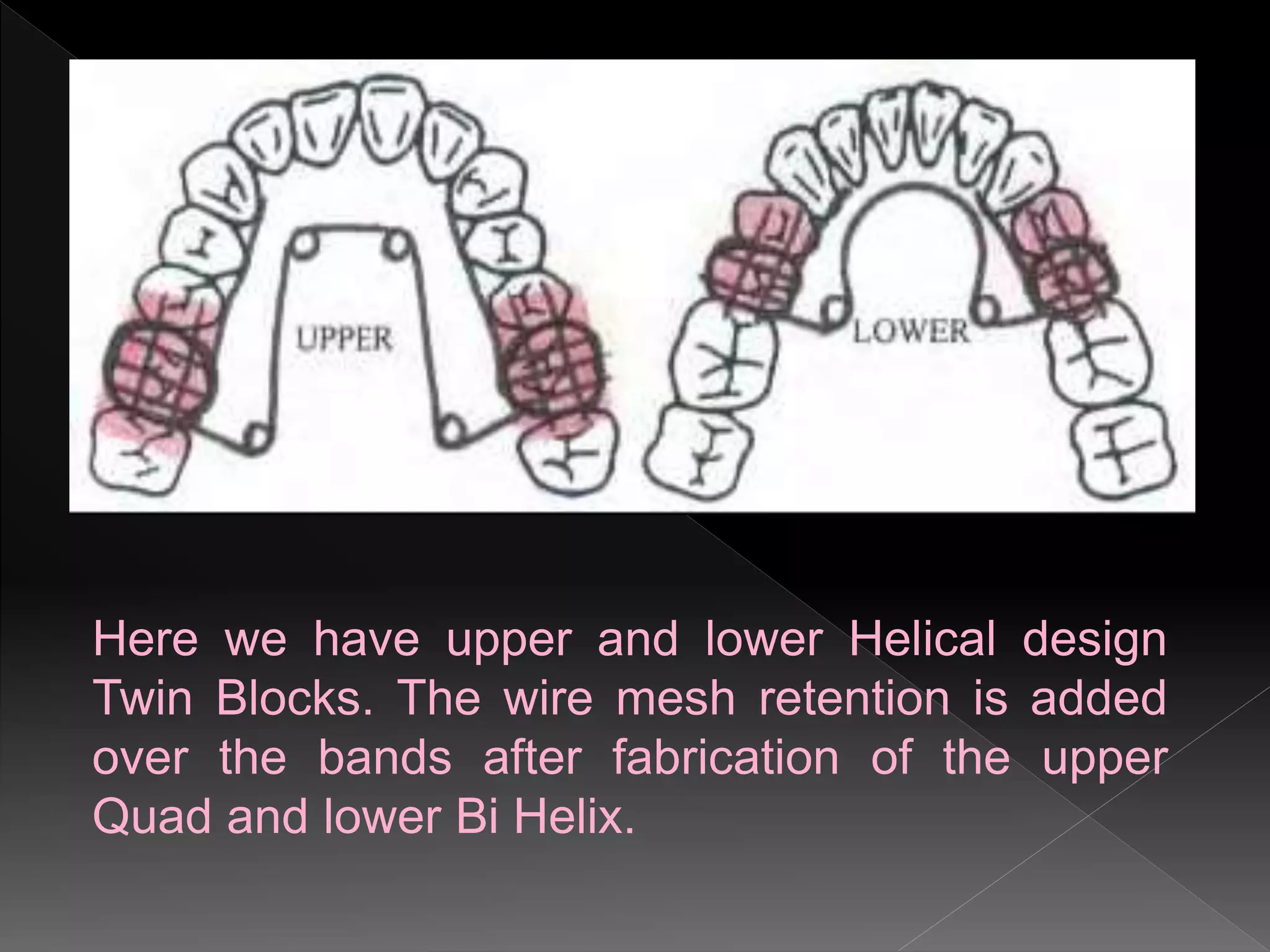 Here we have upper and lower Helical design
Twin Blocks. The wire mesh retention is added
over the bands after fabrication of the upper
Quad and lower Bi Helix.
 