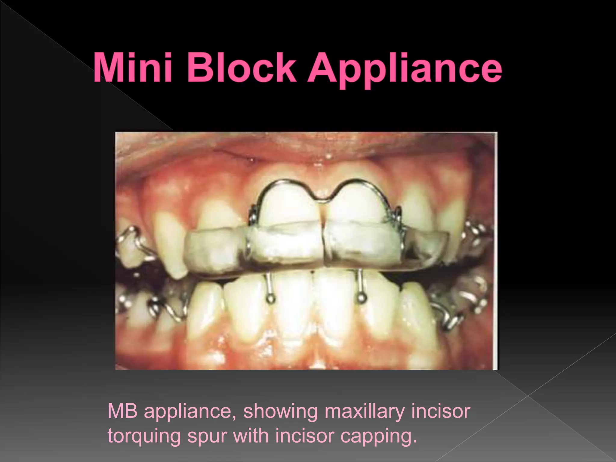 MB appliance, showing maxillary incisor
torquing spur with incisor capping.
 