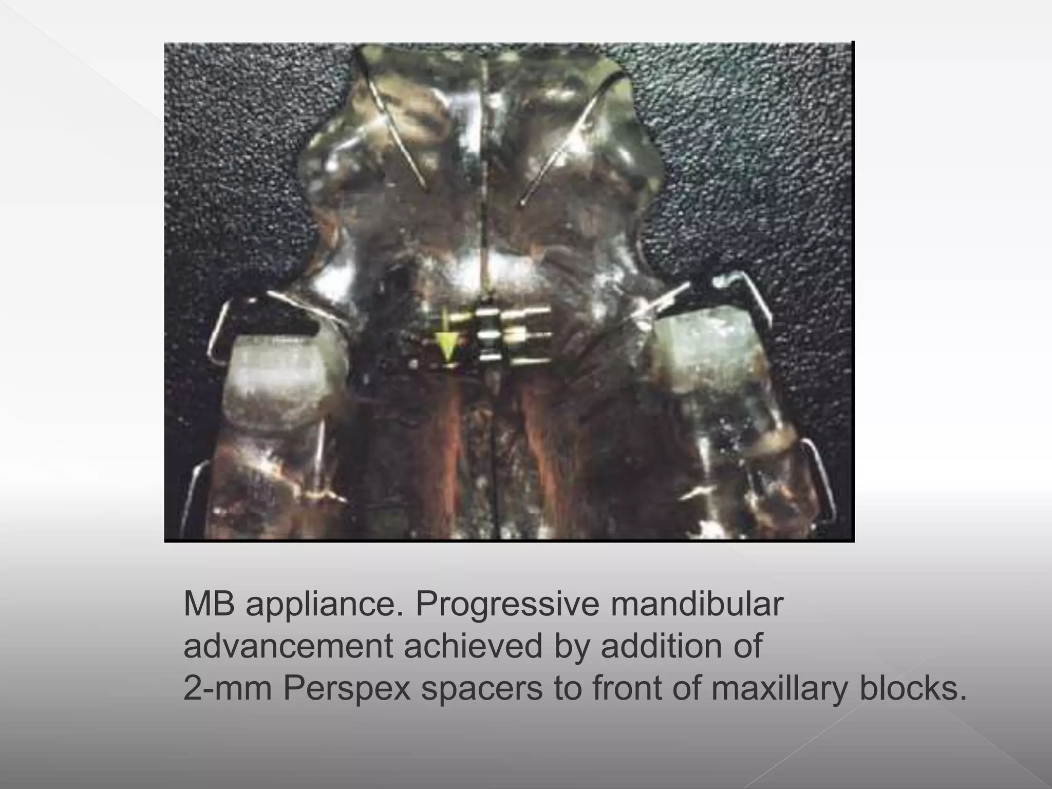 MB appliance. Progressive mandibular
advancement achieved by addition of
2-mm Perspex spacers to front of maxillary blocks.
 