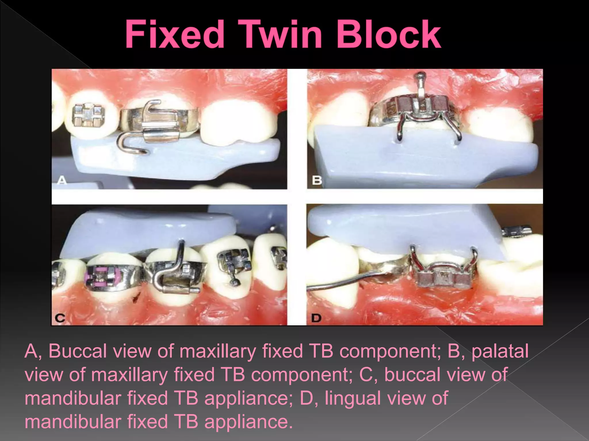 A, Buccal view of maxillary fixed TB component; B, palatal
view of maxillary fixed TB component; C, buccal view of
mandibular fixed TB appliance; D, lingual view of
mandibular fixed TB appliance.
 