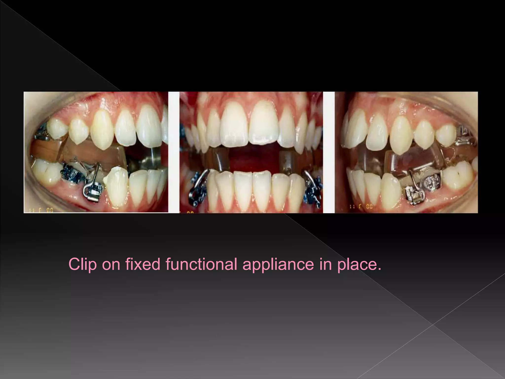 Clip on fixed functional appliance in place.
 