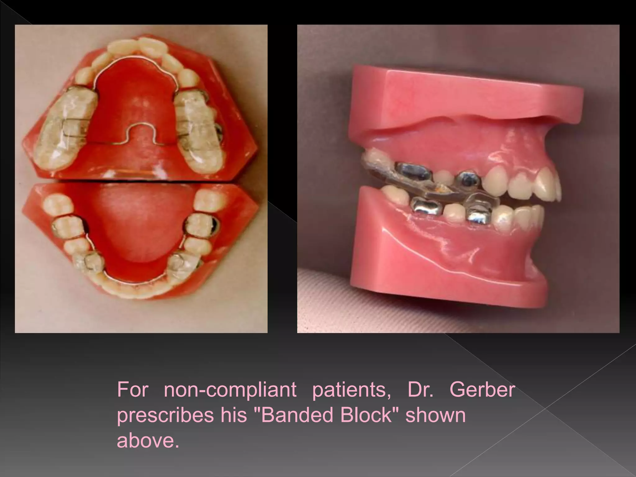 For non-compliant patients, Dr. Gerber
prescribes his "Banded Block" shown
above.
 