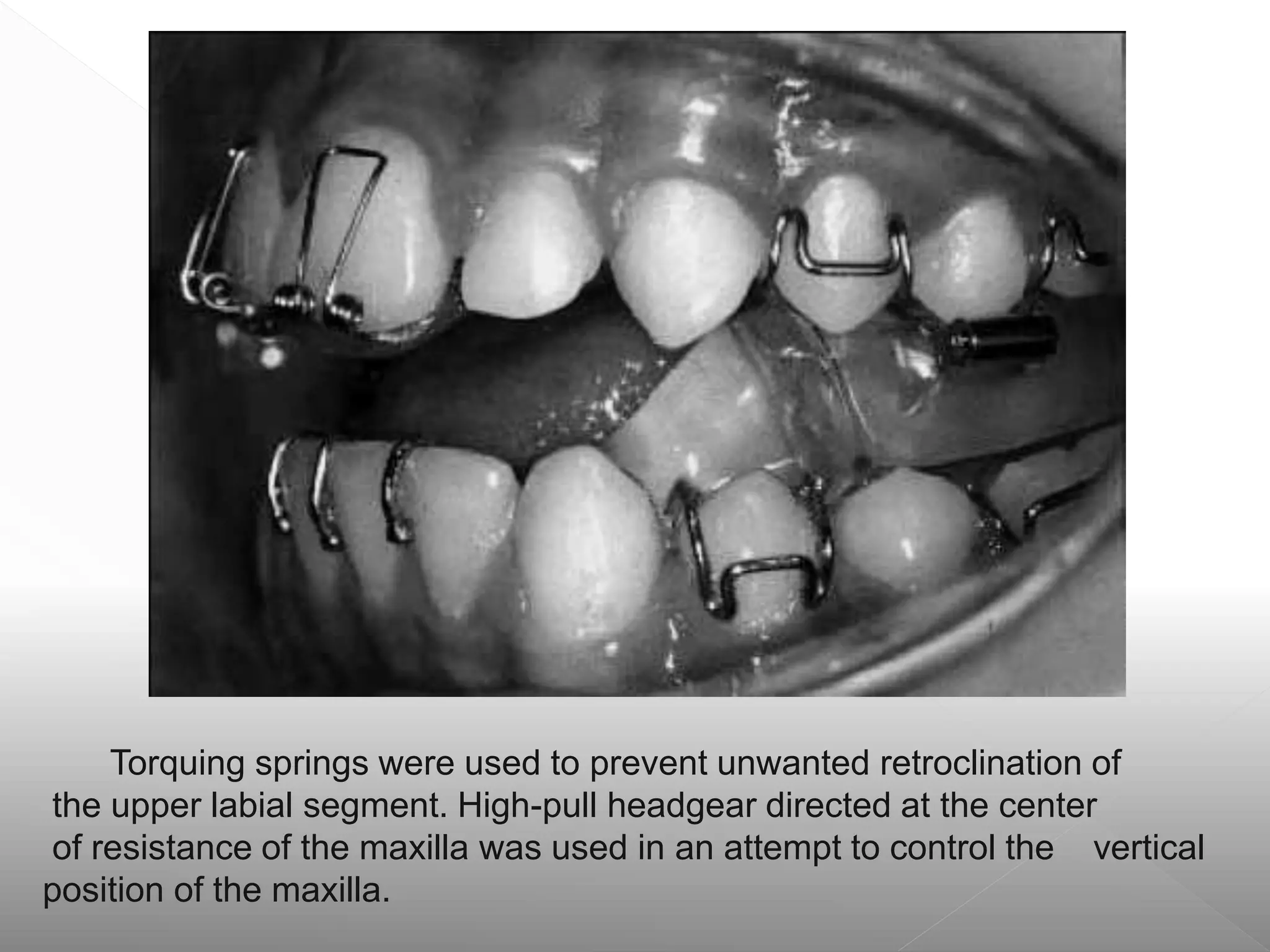 Torquing springs were used to prevent unwanted retroclination of
the upper labial segment. High-pull headgear directed at the center
of resistance of the maxilla was used in an attempt to control the vertical
position of the maxilla.
 