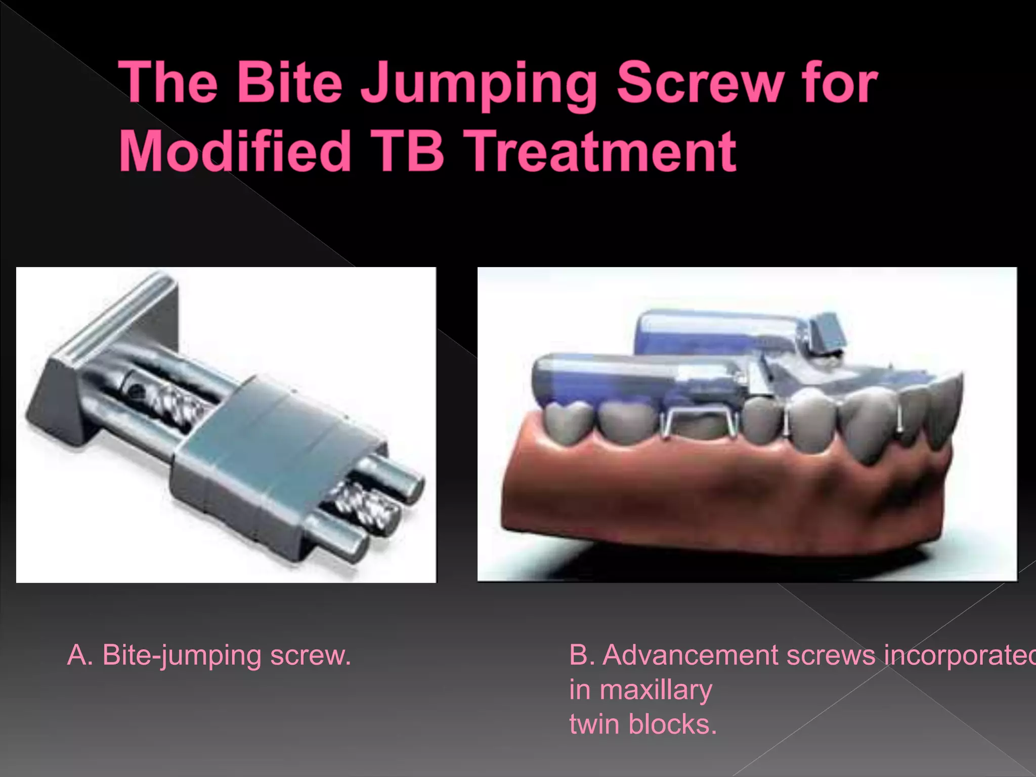 A. Bite-jumping screw. B. Advancement screws incorporated
in maxillary
twin blocks.
 