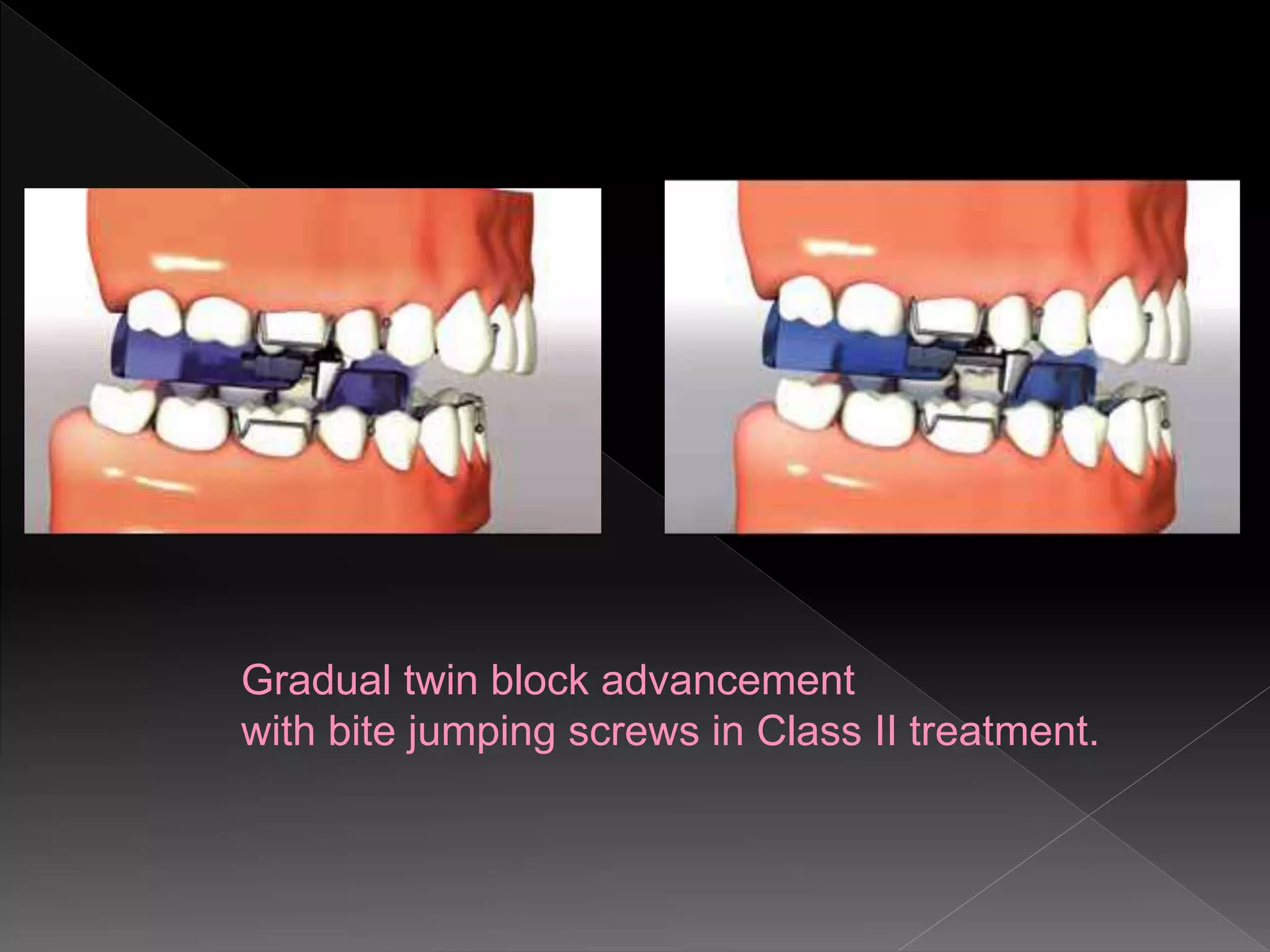 Gradual twin block advancement
with bite jumping screws in Class II treatment.
 