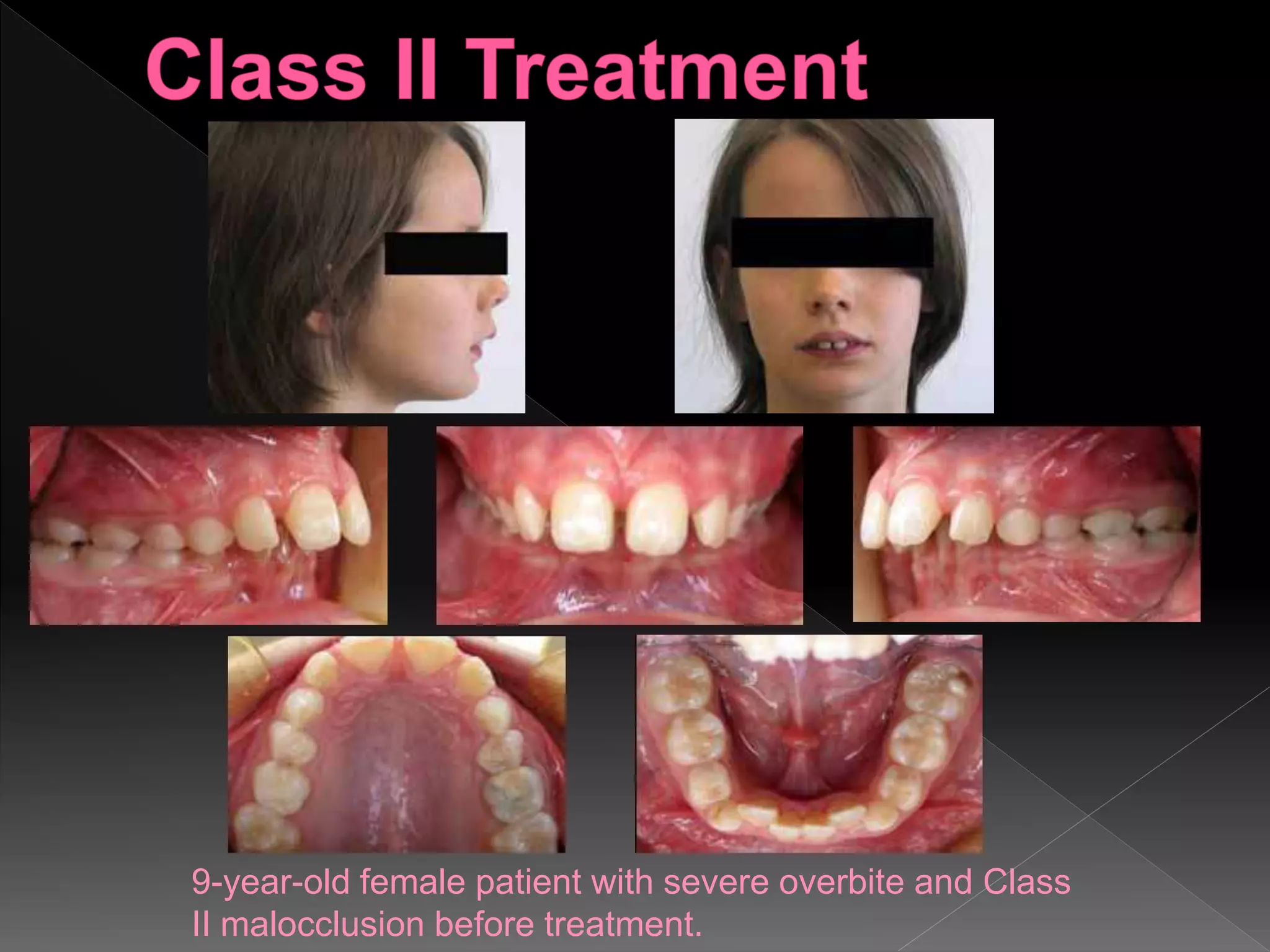 9-year-old female patient with severe overbite and Class
II malocclusion before treatment.
 