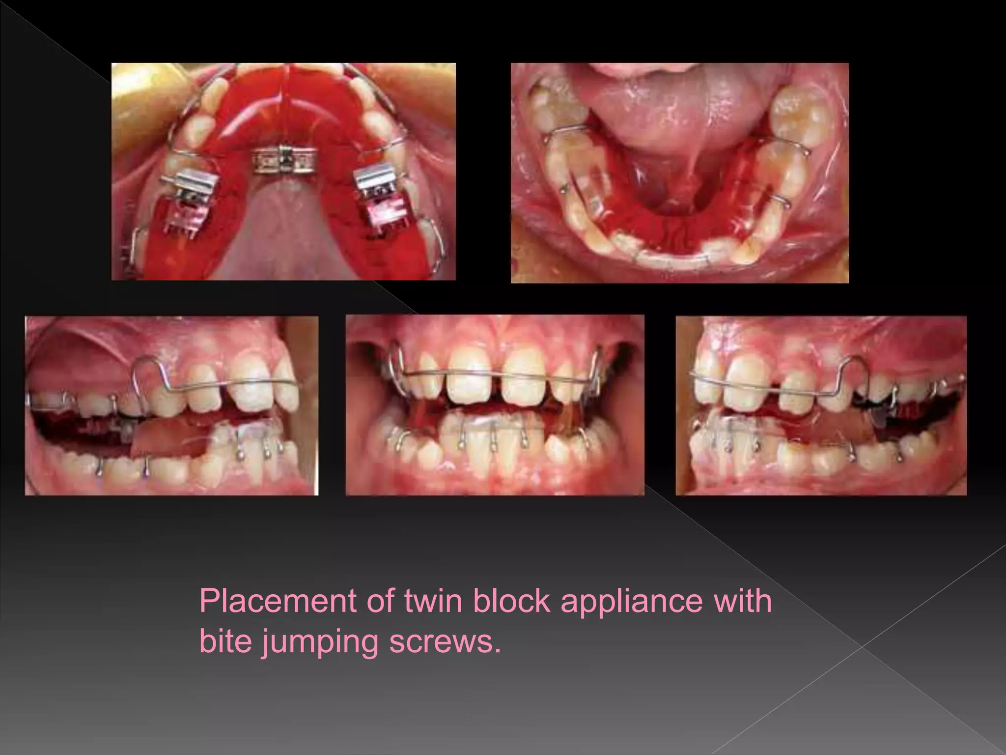 Placement of twin block appliance with
bite jumping screws.
 