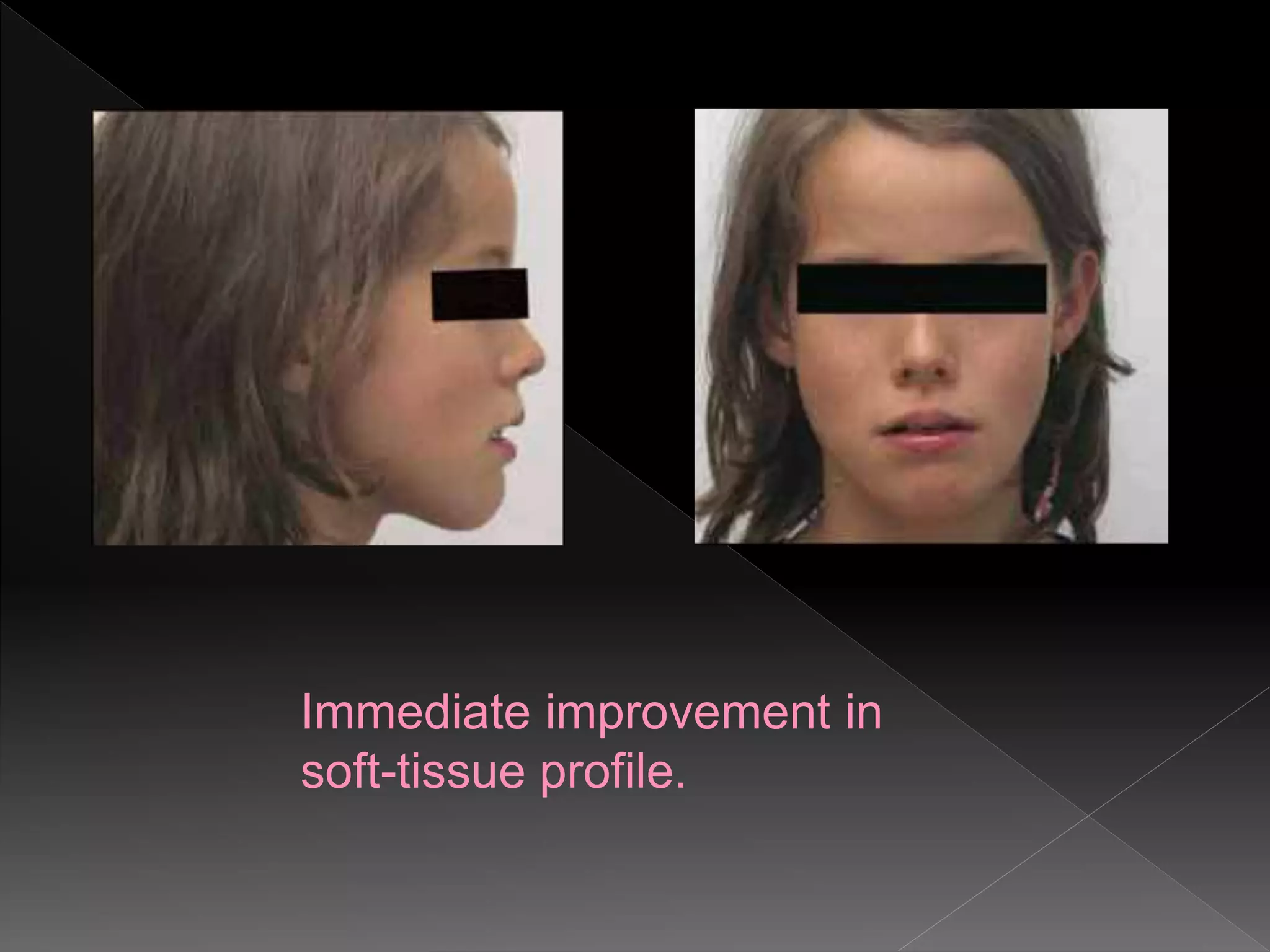 Immediate improvement in
soft-tissue profile.
 