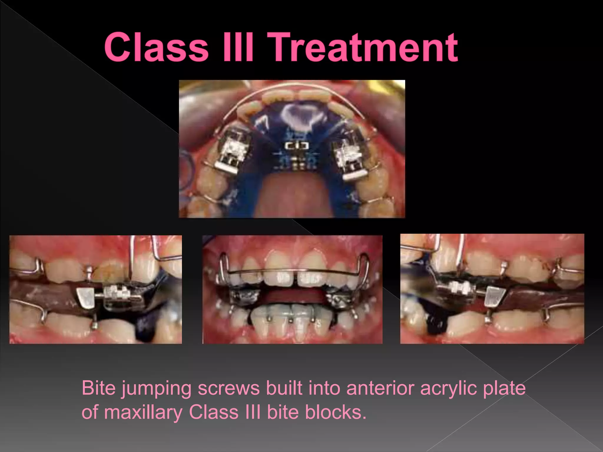 Bite jumping screws built into anterior acrylic plate
of maxillary Class III bite blocks.
 