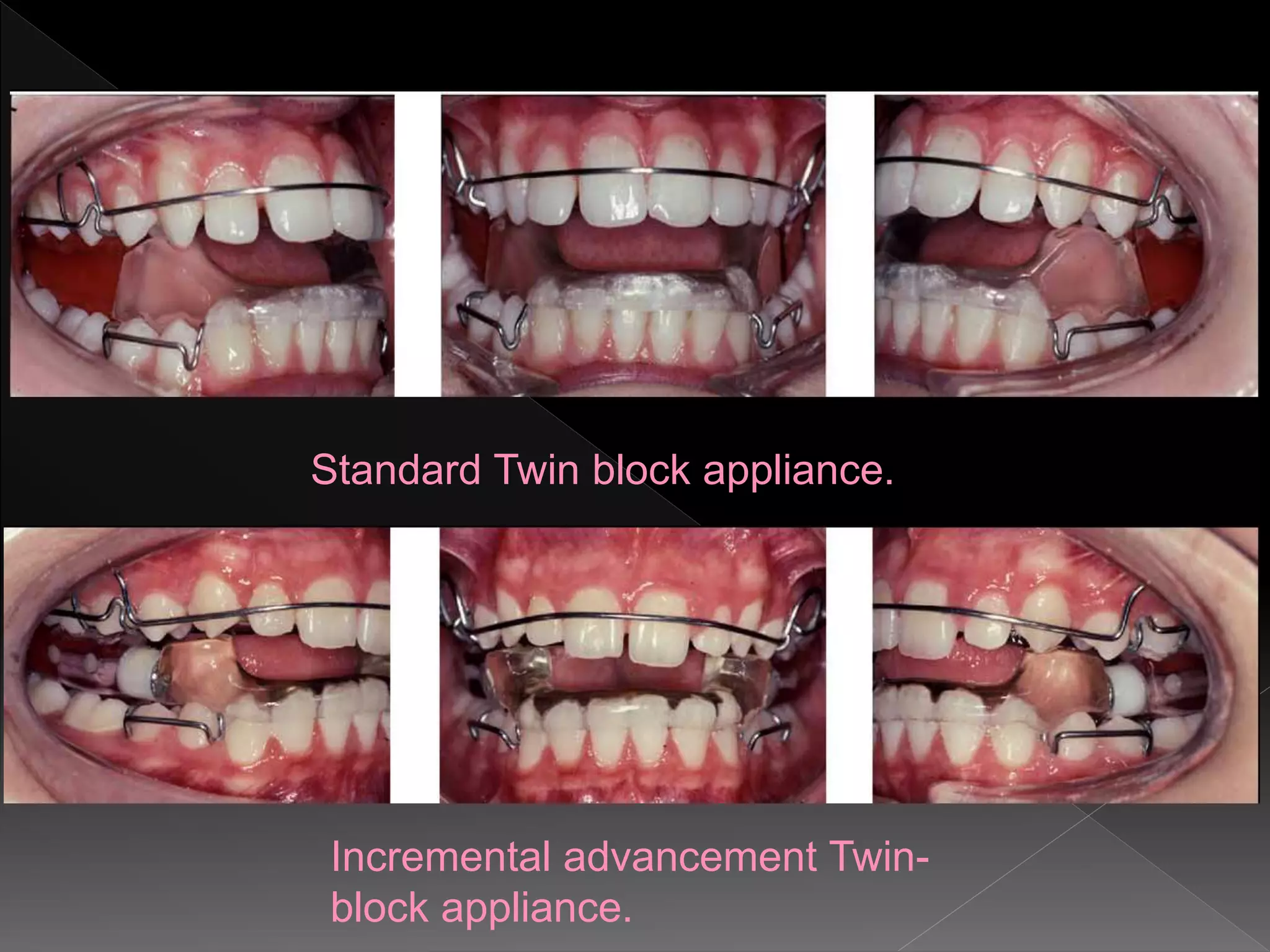 Standard Twin block appliance.
Incremental advancement Twin-
block appliance.
 