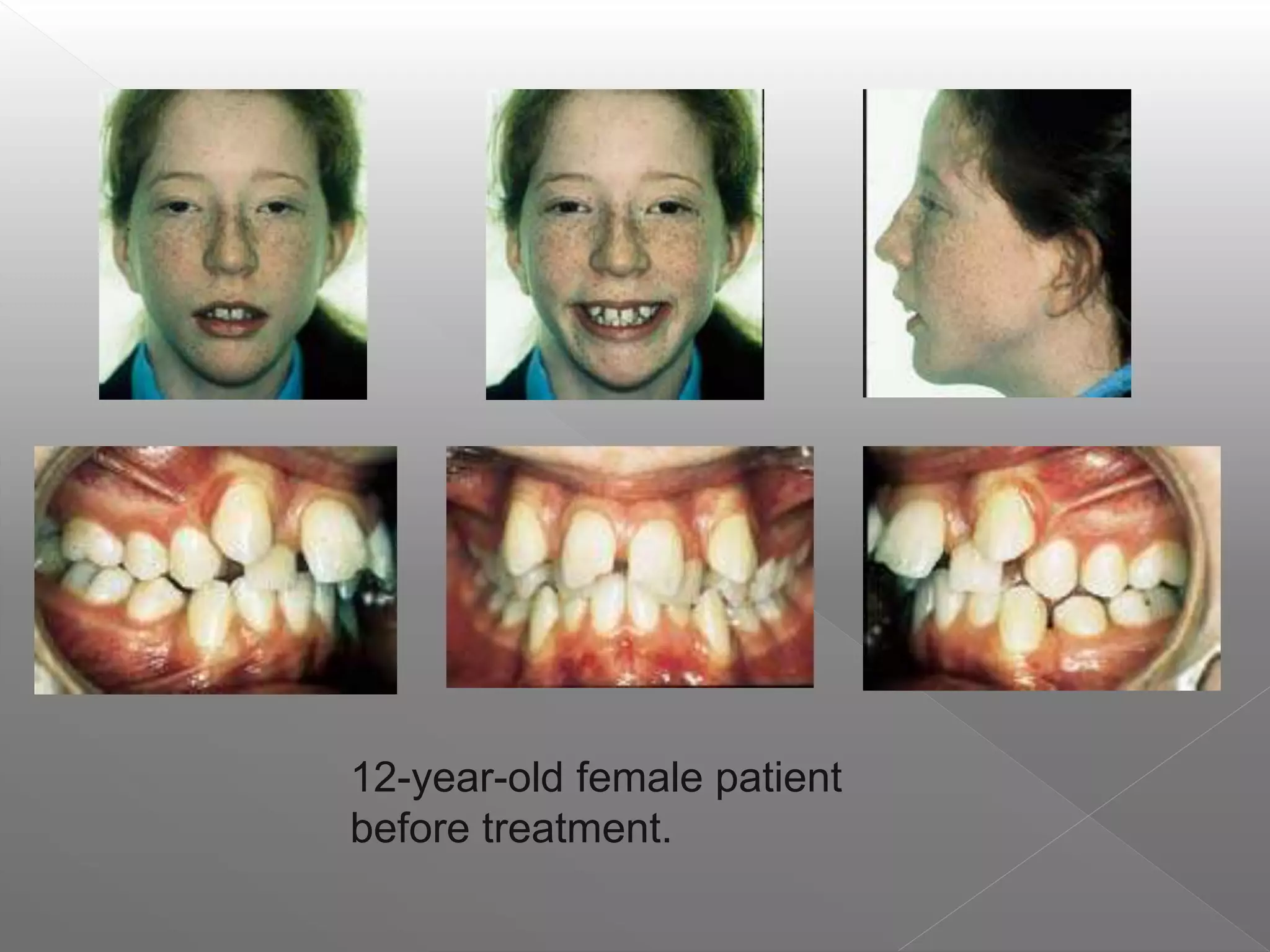 12-year-old female patient
before treatment.
 