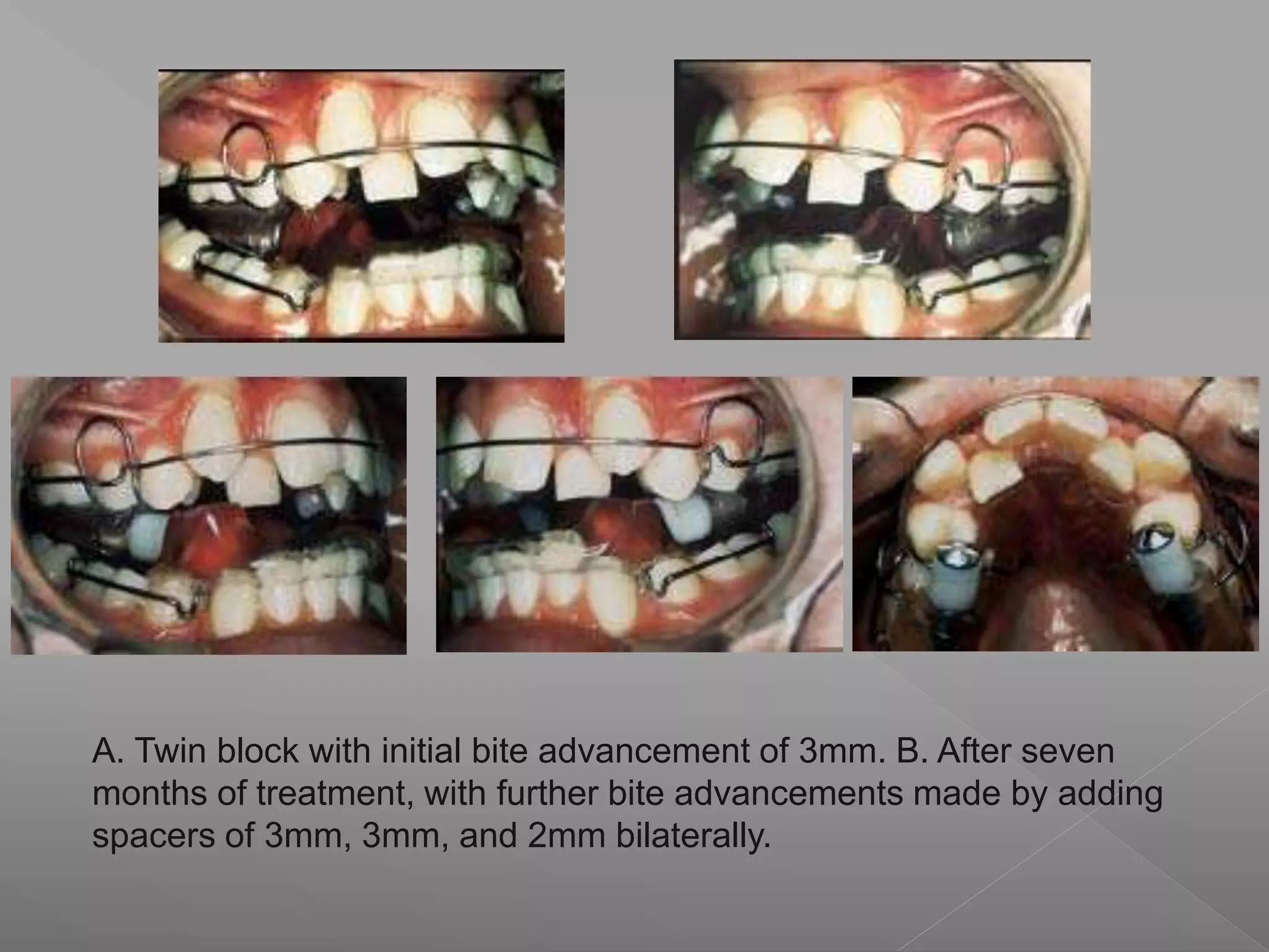 A. Twin block with initial bite advancement of 3mm. B. After seven
months of treatment, with further bite advancements made by adding
spacers of 3mm, 3mm, and 2mm bilaterally.
 