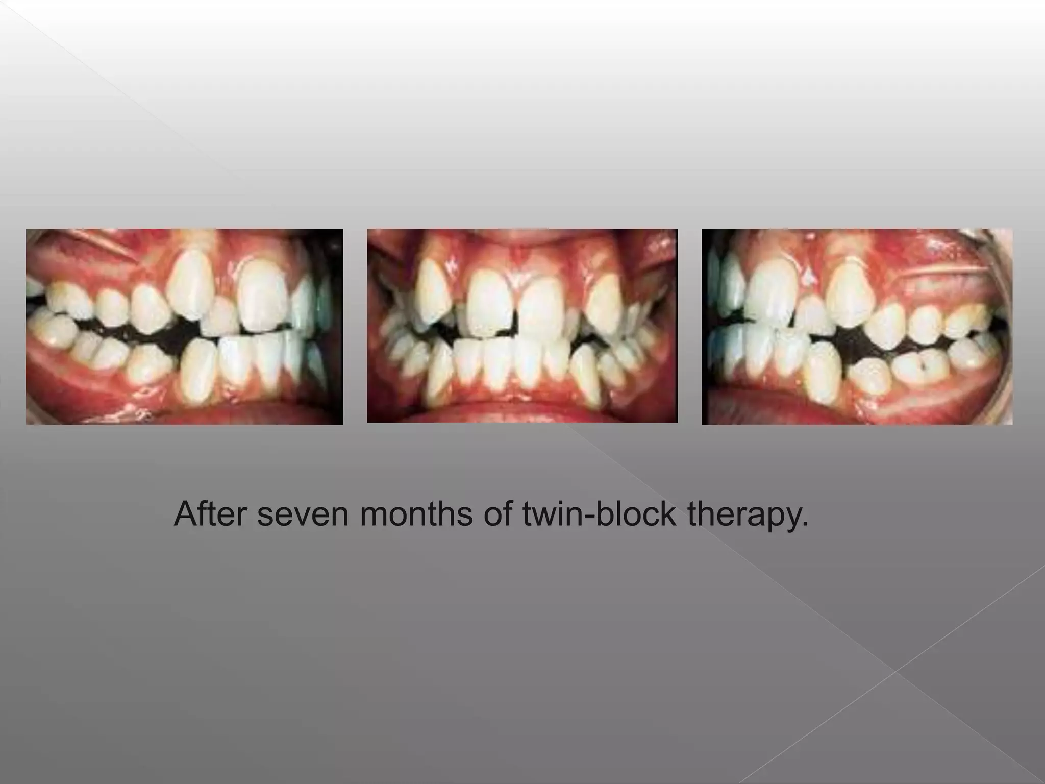 After seven months of twin-block therapy.
 