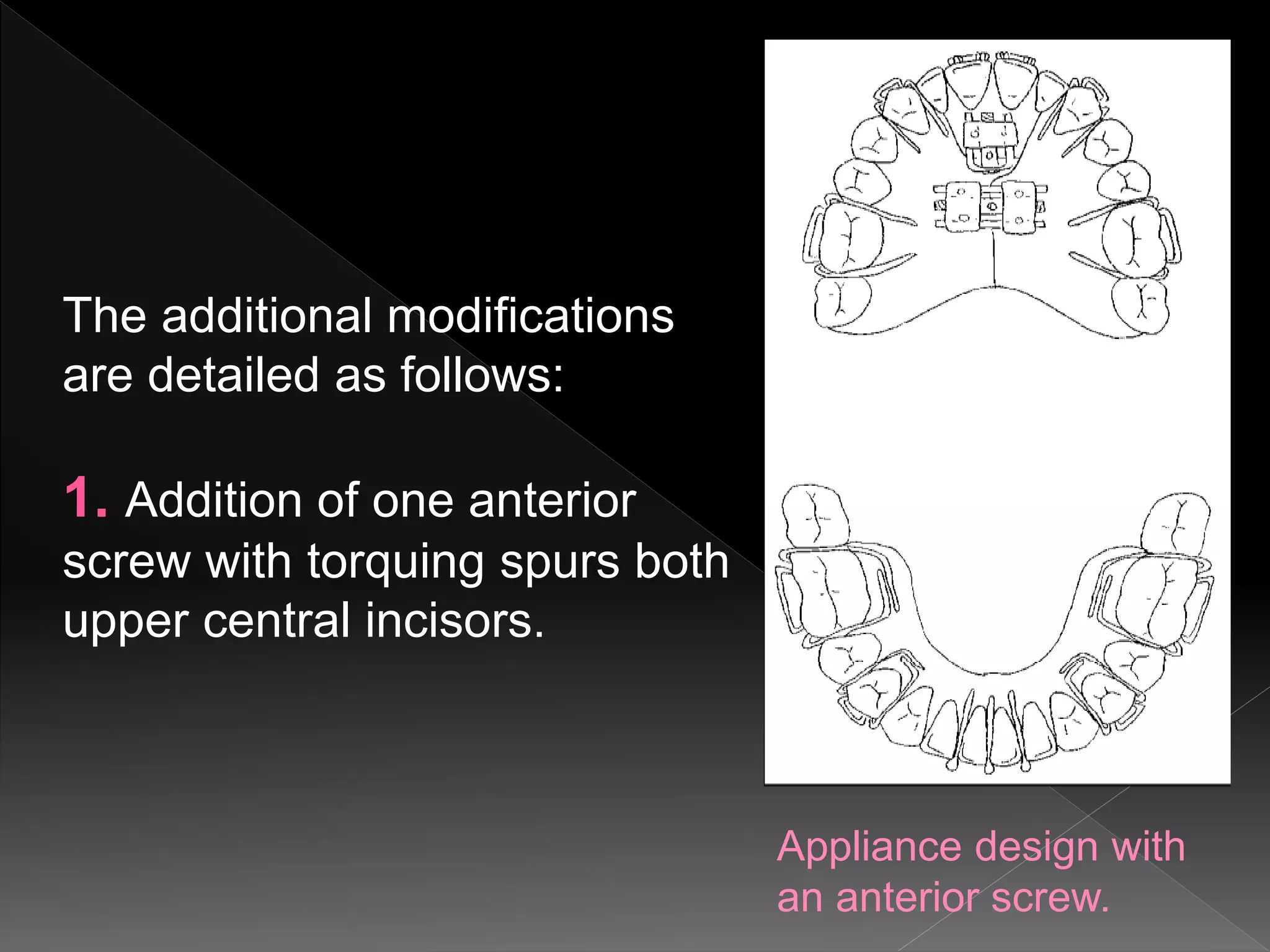 Appliance design with
an anterior screw.
The additional modifications
are detailed as follows:
1. Addition of one anterior
screw with torquing spurs both
upper central incisors.
 