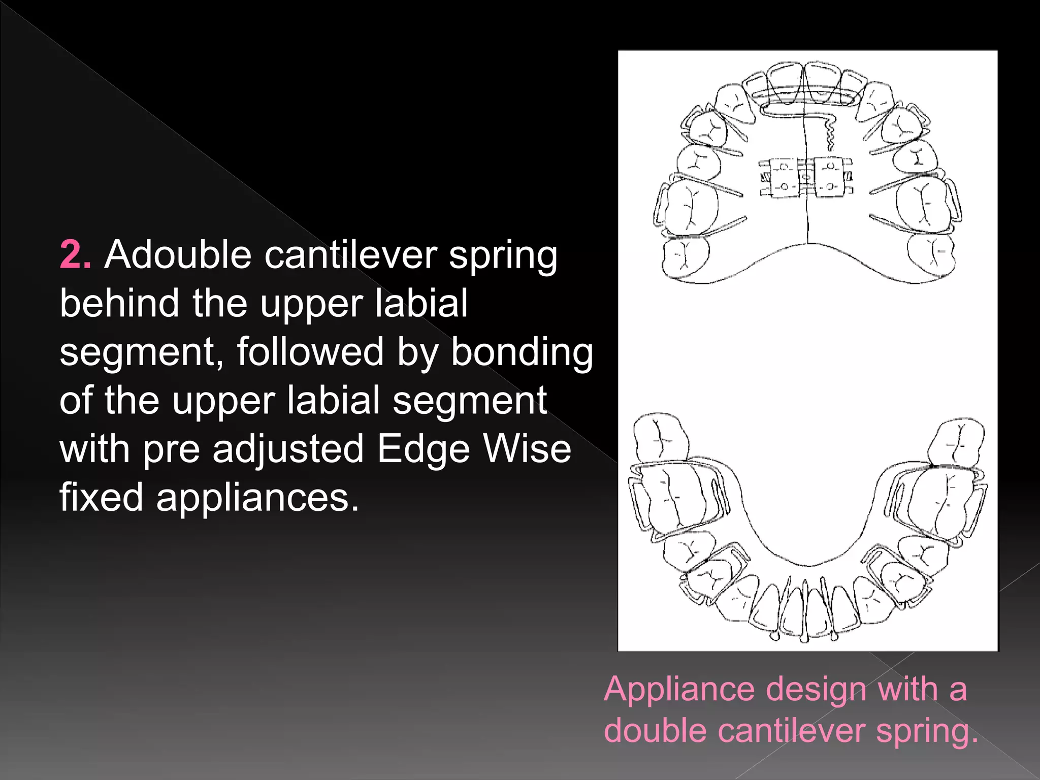 Appliance design with a
double cantilever spring.
2. Adouble cantilever spring
behind the upper labial
segment, followed by bonding
of the upper labial segment
with pre adjusted Edge Wise
fixed appliances.
 