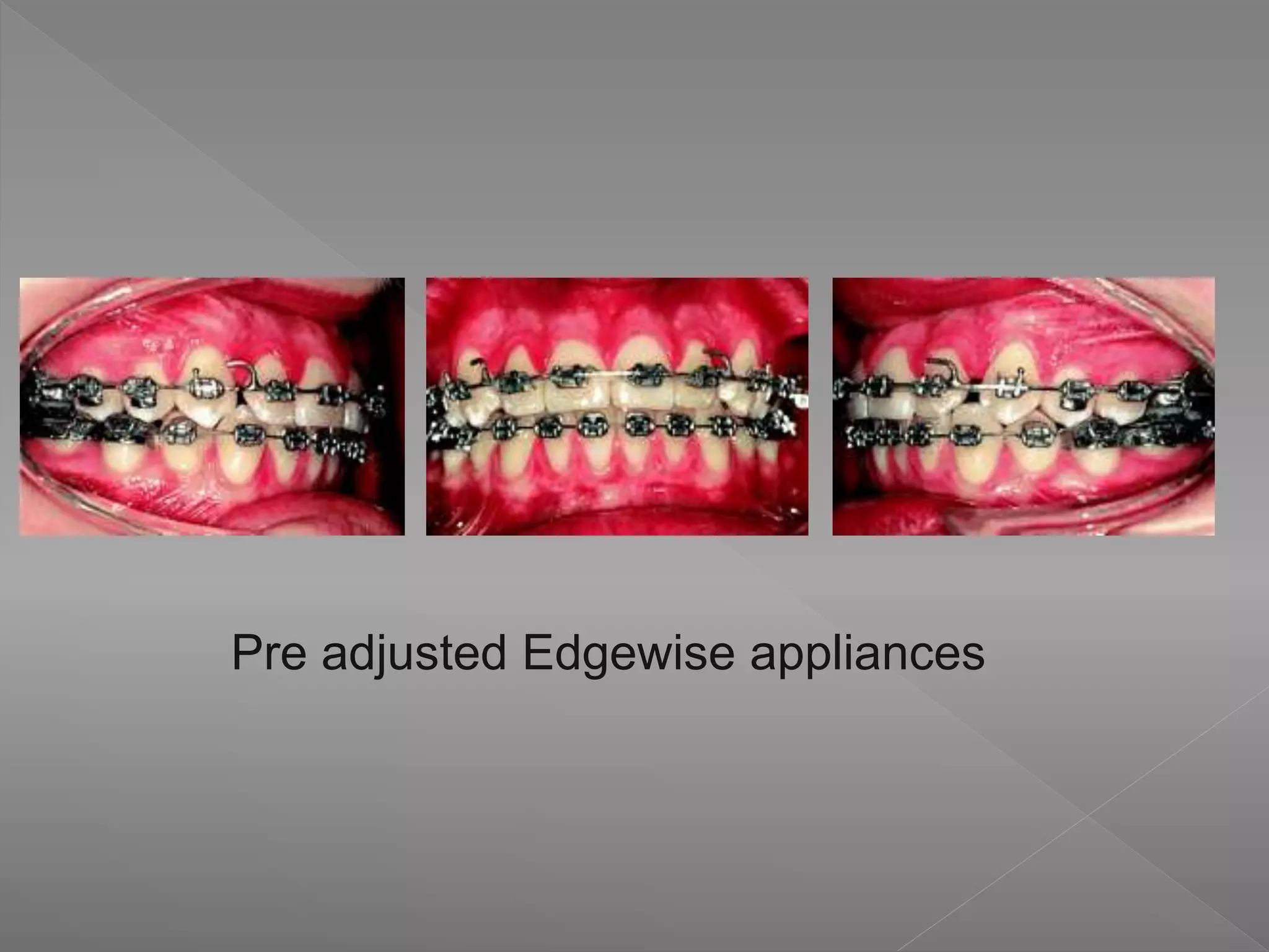 Pre adjusted Edgewise appliances
 
