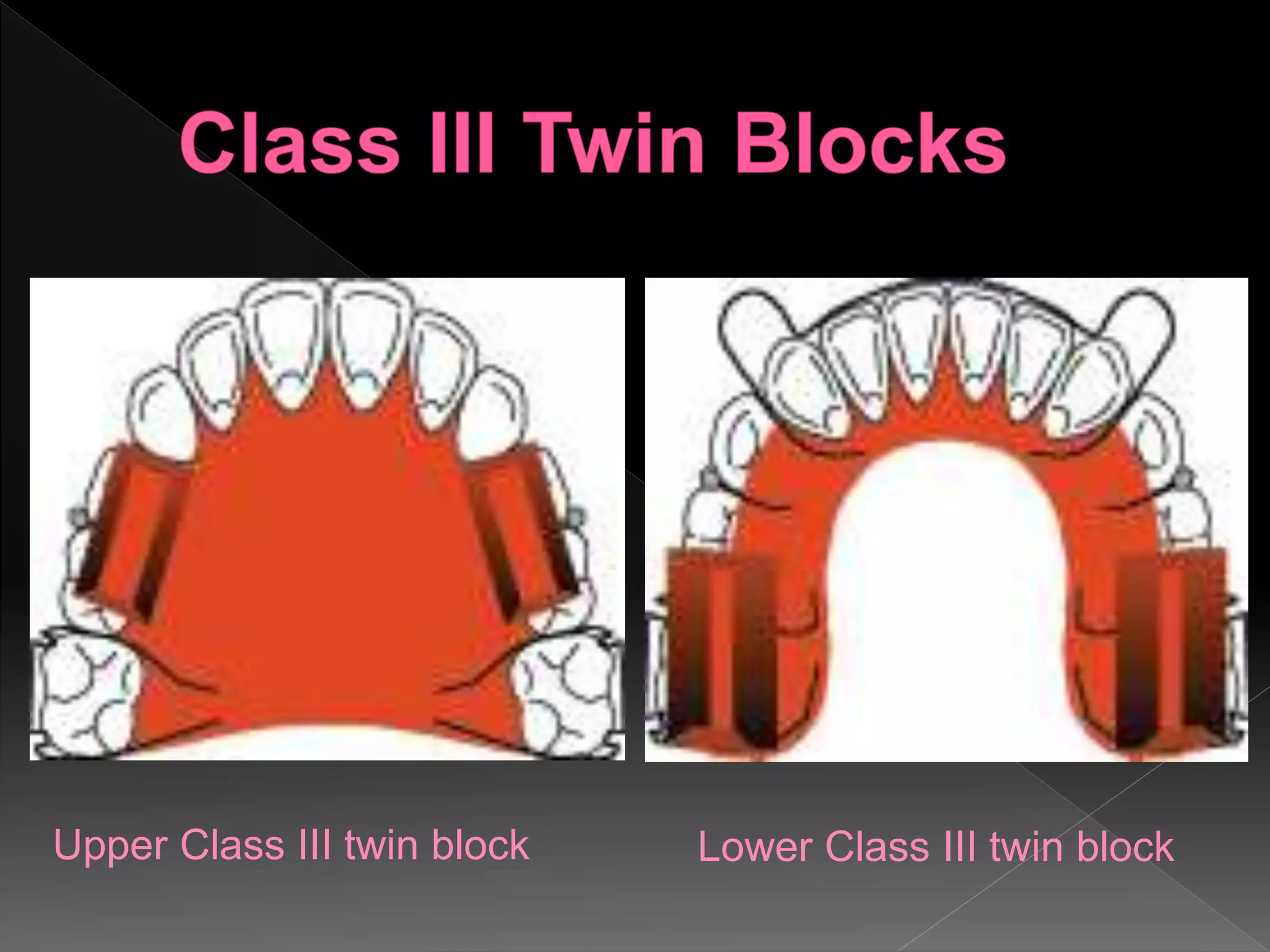 Upper Class III twin block Lower Class III twin block
 