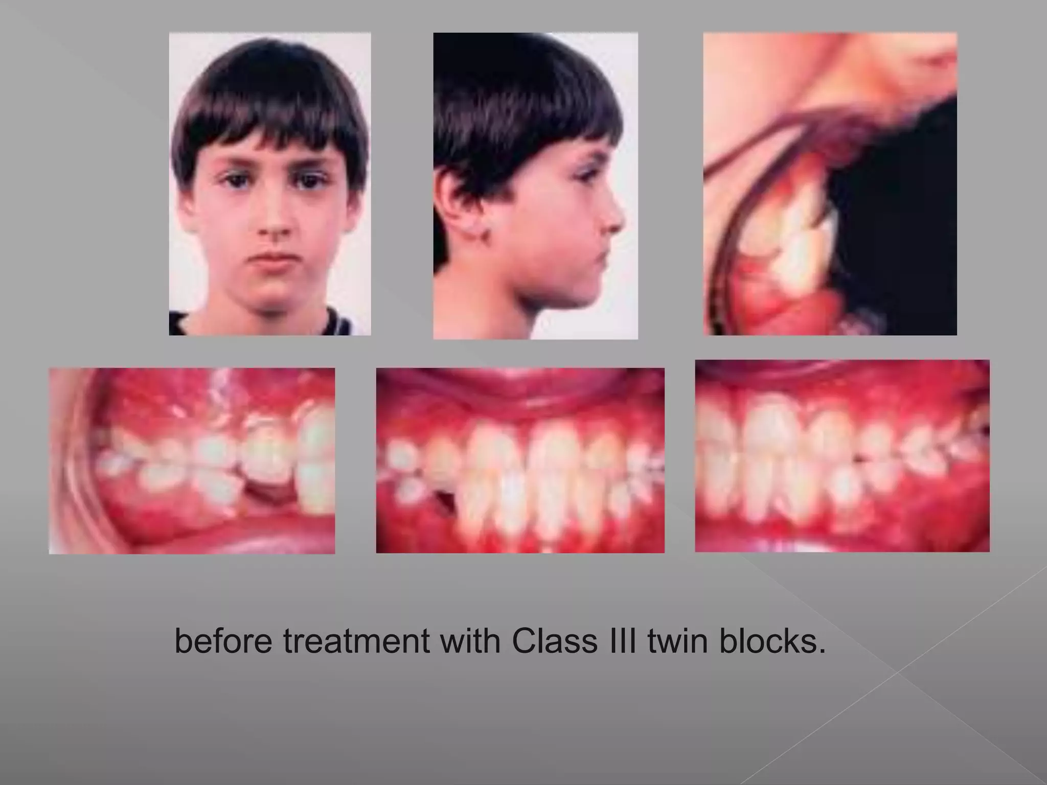 before treatment with Class III twin blocks.
 