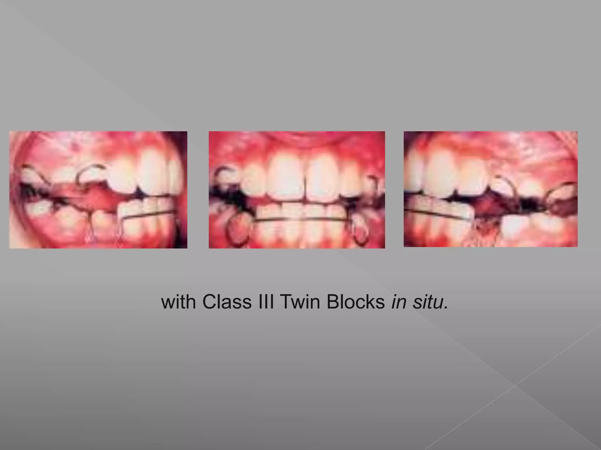 with Class III Twin Blocks in situ.
 