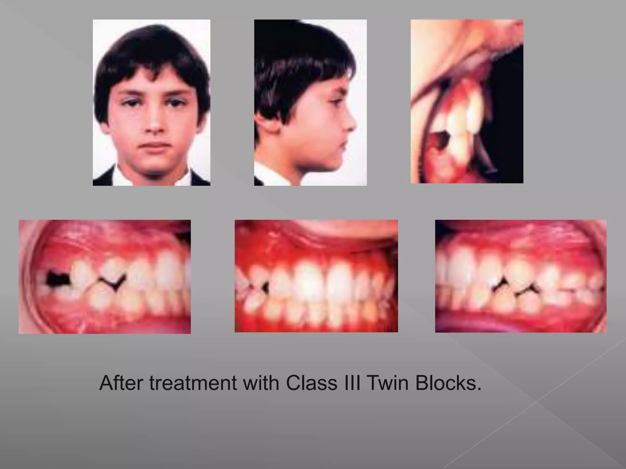 After treatment with Class III Twin Blocks.
 