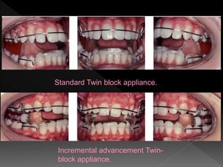 Modification of twin block functional appliance