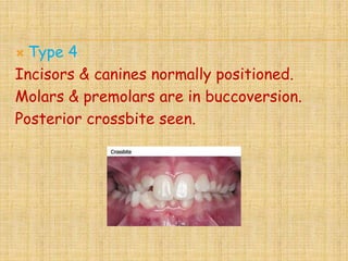  Type 4
Incisors & canines normally positioned.
Molars & premolars are in buccoversion.
Posterior crossbite seen.
 