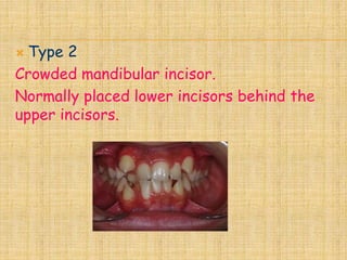  Type 2
Crowded mandibular incisor.
Normally placed lower incisors behind the
upper incisors.
 