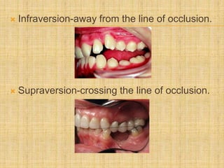  Infraversion-away from the line of occlusion.
 Supraversion-crossing the line of occlusion.
 