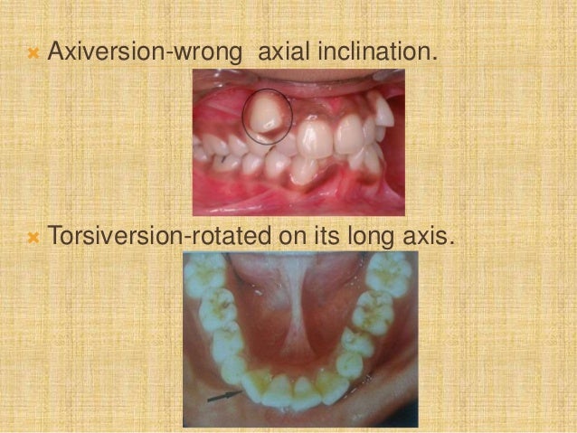 Modifications of angle`s classification