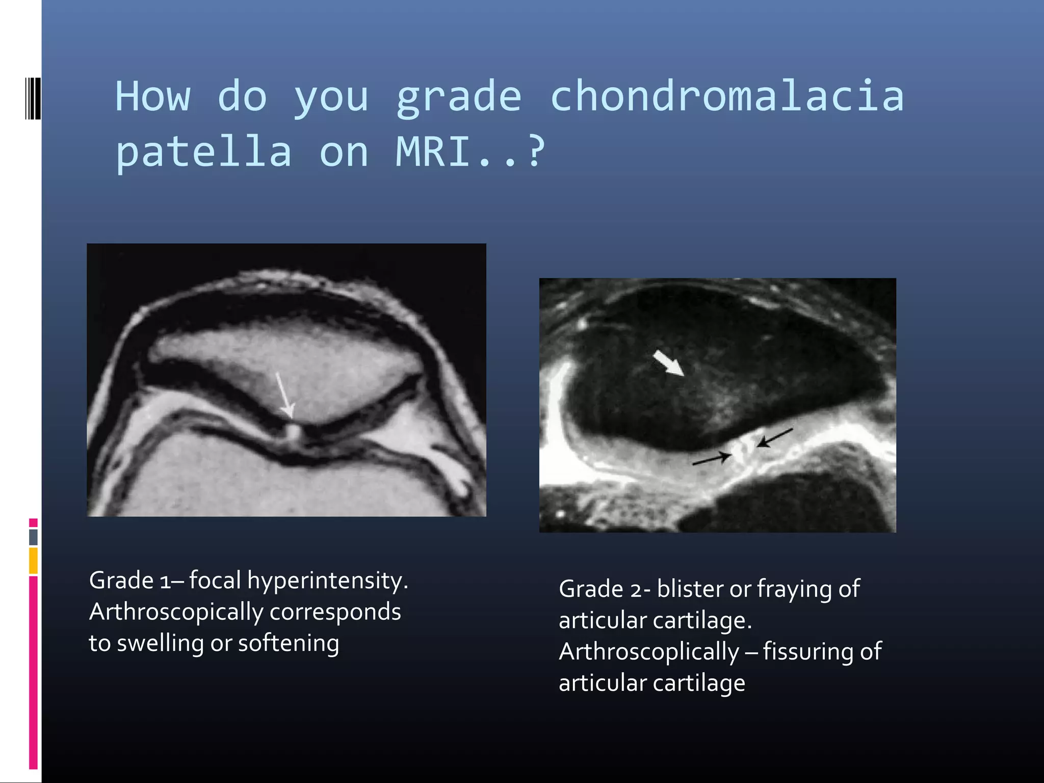 Cartilage imaging simplified PPT