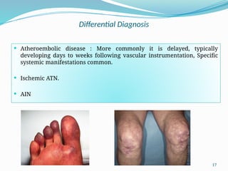 17
Differential Diagnosis
 Atheroembolic disease : More commonly it is delayed, typically
developing days to weeks following vascular instrumentation, Specific
systemic manifestations common.
 Ischemic ATN.
 AIN
 