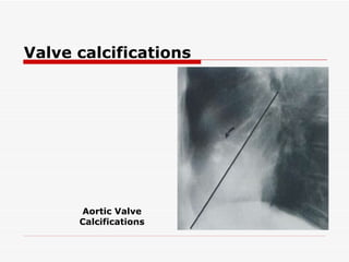 Valve calcifications Aortic Valve Calcifications 