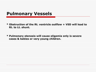 * Obstruction of the Rt. ventricle outflow + VSD will lead to Rt. to Lt. shunt. * Pulmonary stenosis will cause oligemia only is severe cases & babies or very young children.   Pulmonary Vessels 