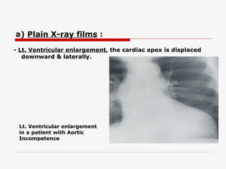 -  Lt. Ventricular enlargement , the cardiac apex is displaced downward & laterally. Lt. Ventricular enlargement in a patient with Aortic Incompetence a)  Plain X-ray films  :   