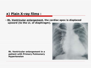 -  Rt. Ventricular enlargement , the cardiac apex is displaced upward (to the Lt. of diaphragm).   Rt. Ventricular enlargement in a patient with Primary Pulmonary Hypertension a)  Plain X-ray films  :   