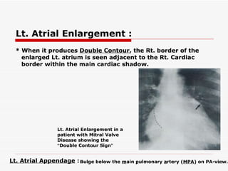 Lt. Atrial Enlargement :   * When it produces  Double Contour , the Rt. border of the enlarged Lt. atrium is seen adjacent to the Rt. Cardiac border within the main cardiac shadow.   Lt. Atrial Appendage  :   Bulge below the  m ain  p ulmonary  a rtery ( MPA ) on PA-view.   Lt. Atrial Enlargement in a patient with Mitral Valve Disease showing the  “ Double Contour Sign ” 