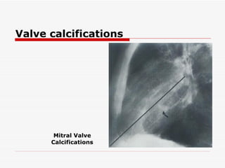 Valve calcifications Mitral Valve Calcifications 