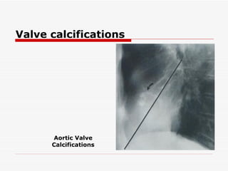 Valve calcifications Aortic Valve Calcifications 