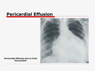 Pericardial Effusion Pericardial Effusion due to Viral Pericarditis 