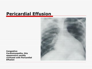 Pericardial Effusion Congestive Cardiomyopathy, this appearance usually confused with Pericardial Effusion 