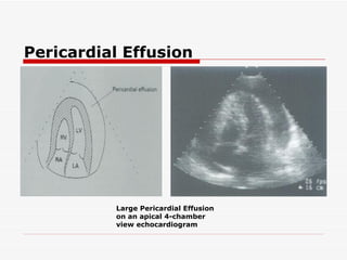 Pericardial Effusion Large Pericardial Effusion on an apical 4-chamber view echocardiogram 