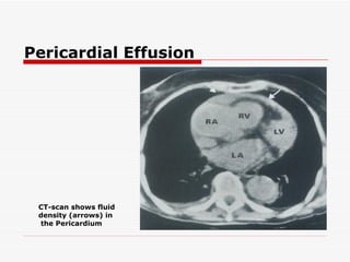 CT-scan shows fluid density (arrows) in the Pericardium  Pericardial Effusion 