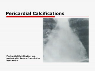 Pericardial Calcifications Pericardial Calcification in a patient with Severe Constrictive Pericarditis 