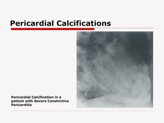 Pericardial Calcifications Pericardial Calcification in a patient with Severe Constrictive Pericarditis 