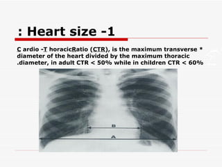 1- Heart size :  *  C ardio -  T horacic  R atio ( CTR ), is the maximum transverse diameter of the heart divided by the maximum thoracic diameter, in adult CTR < 50% while in children CTR < 60%. 
