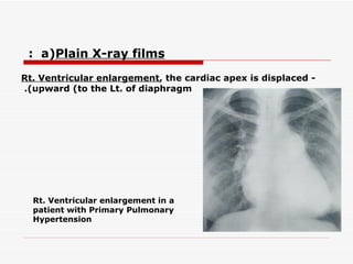 -  Rt. Ventricular enlargement , the cardiac apex is displaced upward (to the Lt. of diaphragm).   Rt. Ventricular enlargement in a patient with Primary Pulmonary Hypertension a)  Plain X-ray films  :   